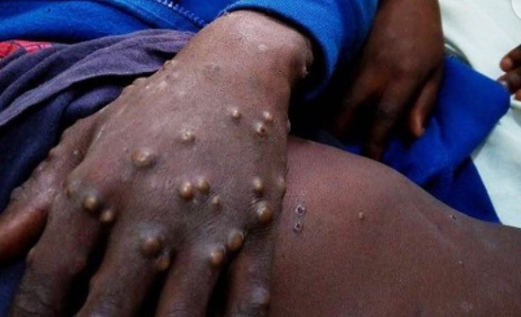 Monkeypox: Govt tightens noose on travellers from Europe, others