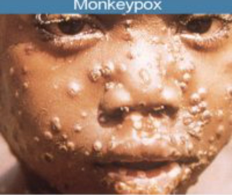 Nigeria’s at Risk as Monkeypox Cases Increase,  Death Recorded in..